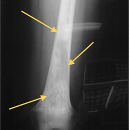 Epitheliod Hemangioendothelioma