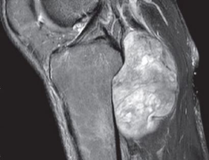 Popliteal Mri