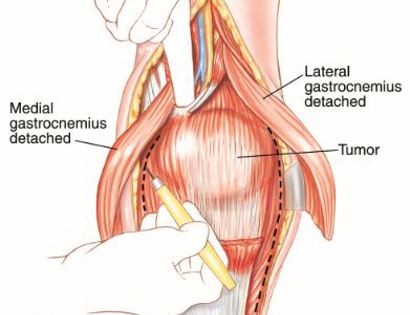 Tumor removal schematic 