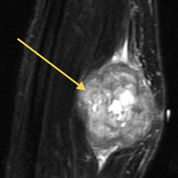 Leimysosarcoma