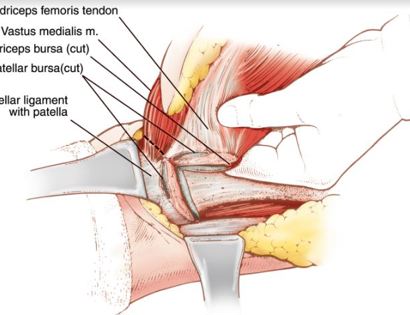 Extent of Tumor Removal 