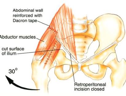 Soft Tissue Coverage 