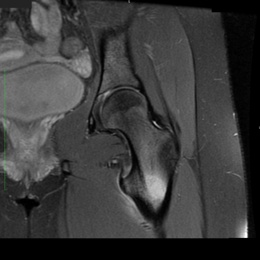 18B) Osteoid Osteoma Case 2 MR COR PD FATSAT LEFT