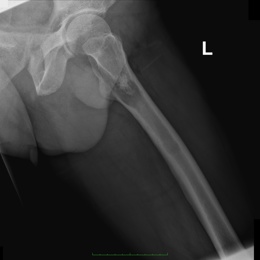 15B) Dedifferentiated Chondrosarcoma Left Femur XR Lateral T HIP FROG Left