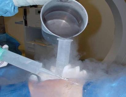 Cryosurgery