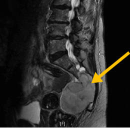 Chordoma