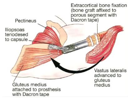 Soft Tissue Coverage 