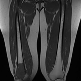 102C) Coronal T1 MRI Of Right Femur MFH