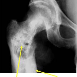 Dedifferentiated Chondrosarcoma