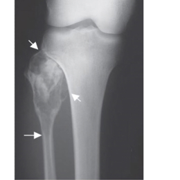 Fibular Resection