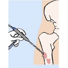 Radiofrequency Ablation