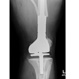 Distal Femur Tumor Prosthesis Replacement