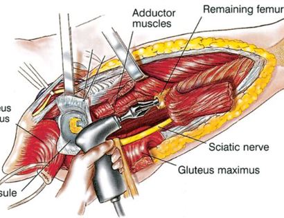 Reaming Femur 