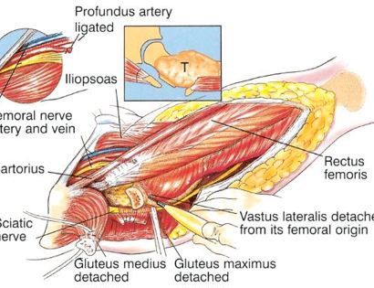 Tumor Removal 