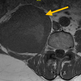 Undifferentiated Pleomorphic Sarcoma