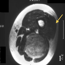 Neurofibroma