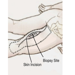 Resection of the posterior component of the thigh