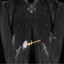 Round Cell Liposarcoma