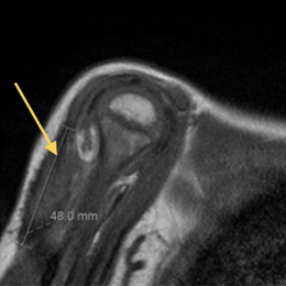 Infantile Fibromatosis