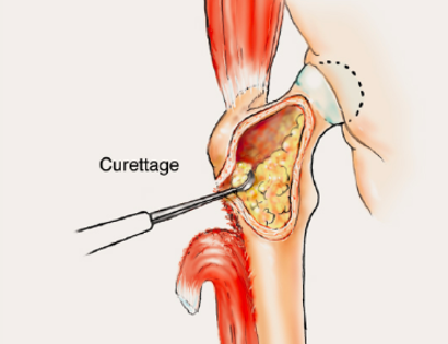 Intralesional Curettage 