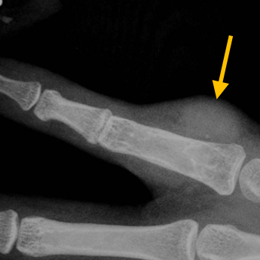 Giant Cell Tumor of Tendon Sheath