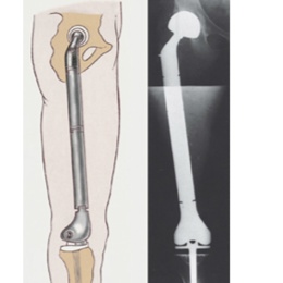 Total Femur Tumor Prosthesis