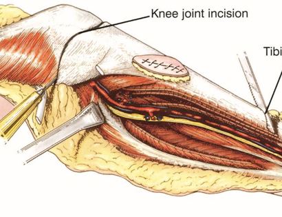 Tumor Removal 