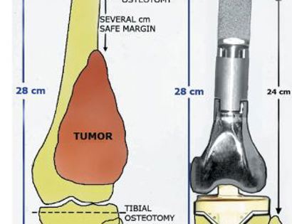 Joint Replacement