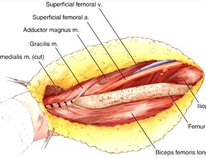 Reconstruction 