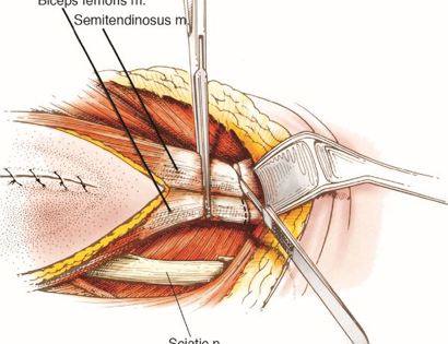 Hamstrings Removal 