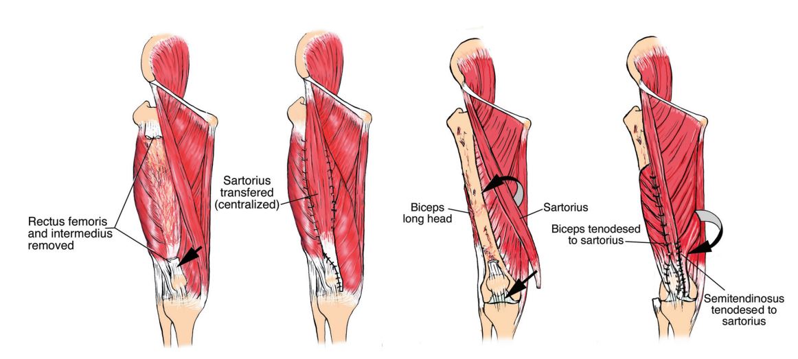 Quadriceps Transferred (1)