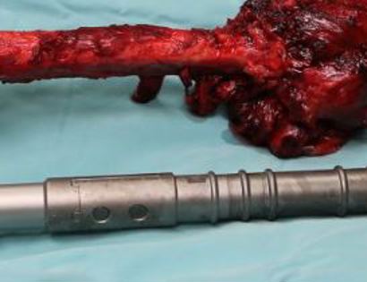 Intra-Op: Total Femur Specimen and Prosthesis 