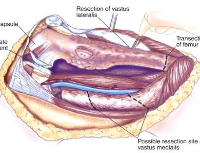 Tumor Removal Surgical Cuts