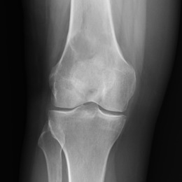 102A) Plain AP Xray Of Right Femur MFH