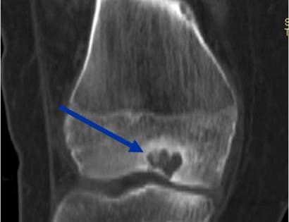 Benign Bone Tumors