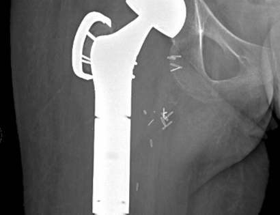 Xray of Prosthesis 