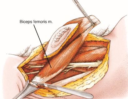 Biceps Femoris Removal 