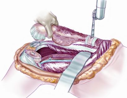 Tumor Removal with Surgical Saw