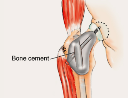 Bone Grafting and Fixation