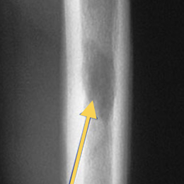 Eosinophilic Granuloma