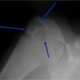 Chondroblastoma13