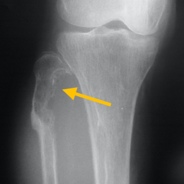 28A) AP XR Of Right Proximal Fibula Hemangiopericytoma (1)