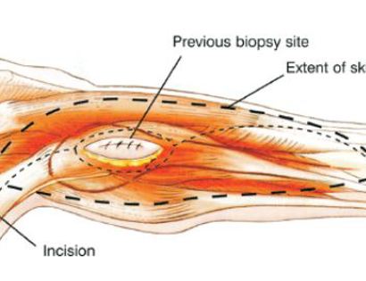 Incision 