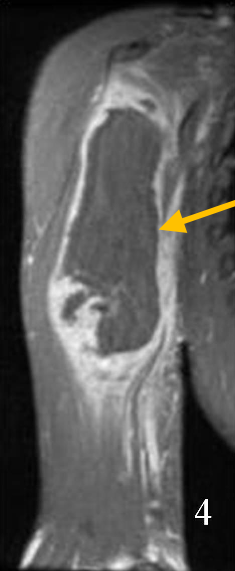 Soft Tissue Sarcomas