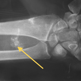 Synovial Sarcoma