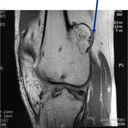 Osteochondroma15b