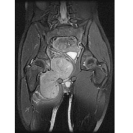 Adductor Muscle Group Excision