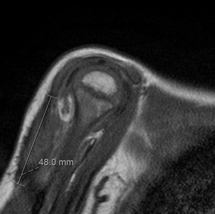 Infantile Fibromatosis2