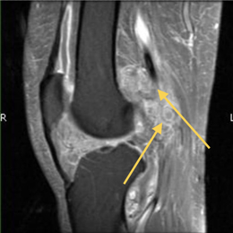 Pigmented Villonodular Synovitis (PVNS)