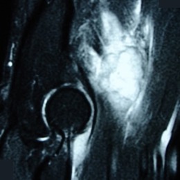 43A) Sagittal MR T2 Of The Right Elbow Clear Cell Sarcoma